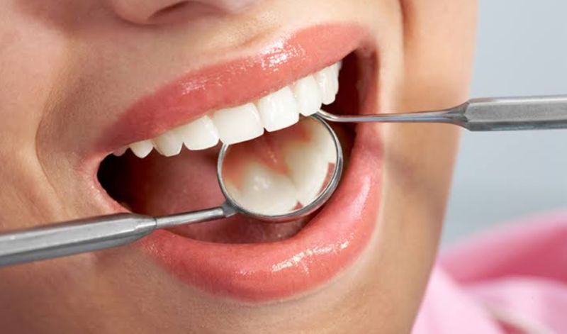 Răng cửa bị sâu có trám được không