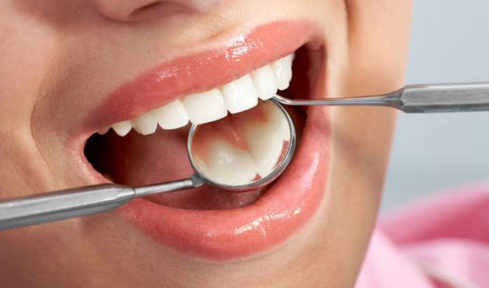 Răng cửa bị sâu có trám được không