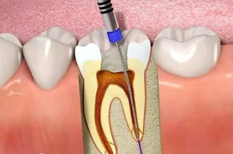 Trám răng lấy tủy có đau không