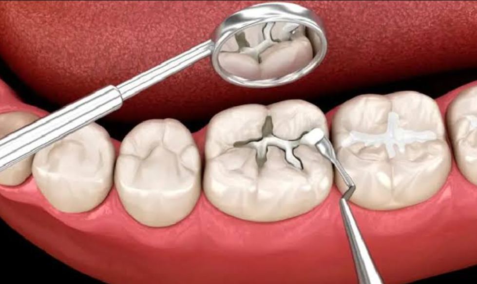 Trám răng sâu có lấy tủy không