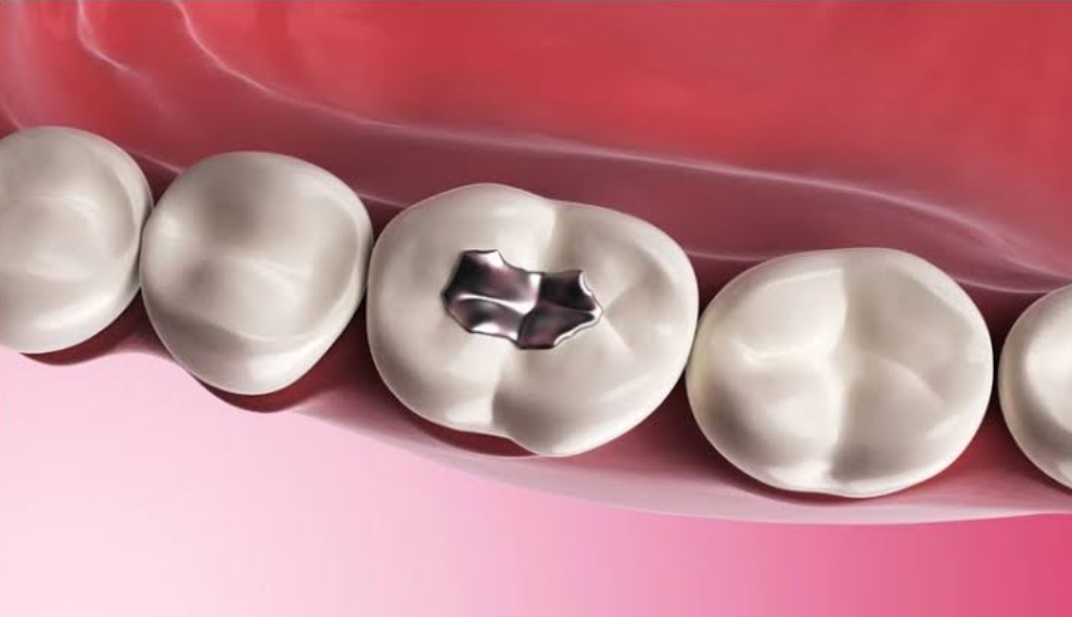 Trám răng thẩm mỹ là gì