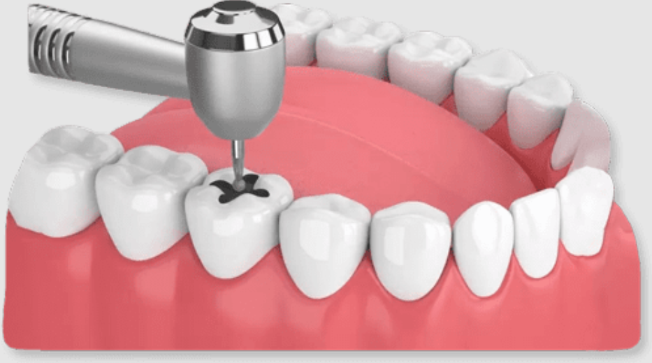 Các bước thực hiện trám răng thẩm mỹ