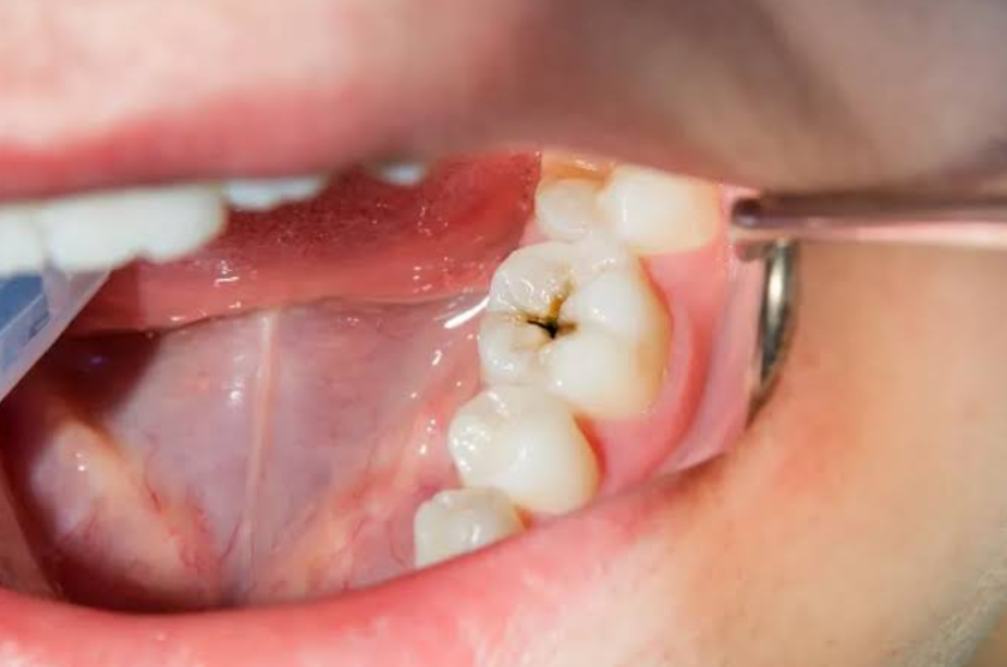 Trường hợp thường cần trám răng lấy tủy