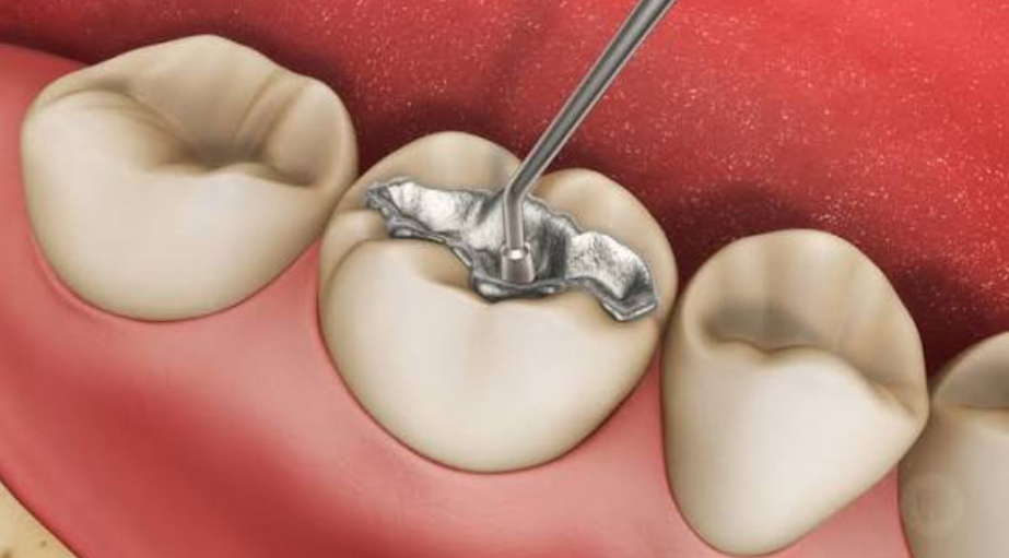 Trám răng sâu kịp thời giúp tiết kiệm về thời gian và chi phí